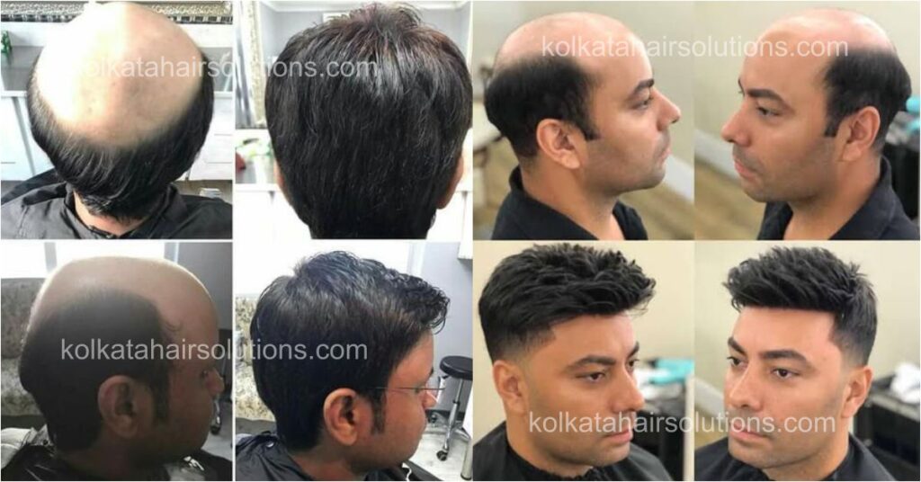 best-hair-wig-and-patch-shop-kolkata-howrah – Kolkata Hair Solutions by  Lotus Stylish