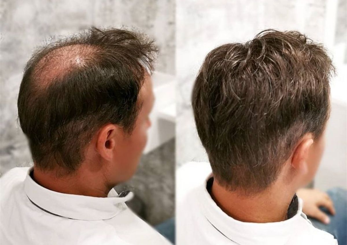 Best hair wigs and hair patches for men in kolkata, starting just ₹4999. Best non surgical hair replacement solution for pattern baldness in men with the help of advanced hair patching with hair wigs and hair patches for men in kolkata.