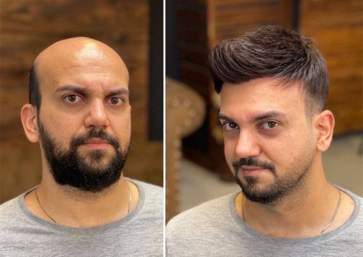 Best hair wigs and hair patches for men in kolkata, starting just ₹4999. Best non surgical hair replacement solution for pattern baldness in men with the help of advanced hair patching with hair wigs and hair patches for men in kolkata.
