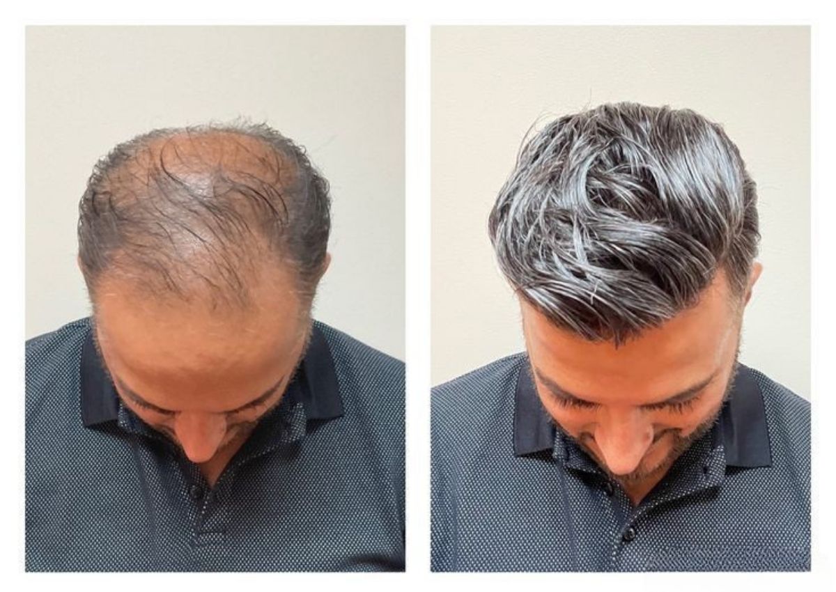 Best hair wigs and hair patches for men in kolkata, starting just ₹4999. Best non surgical hair replacement solution for pattern baldness in men with the help of advanced hair patching with hair wigs and hair patches for men in kolkata.