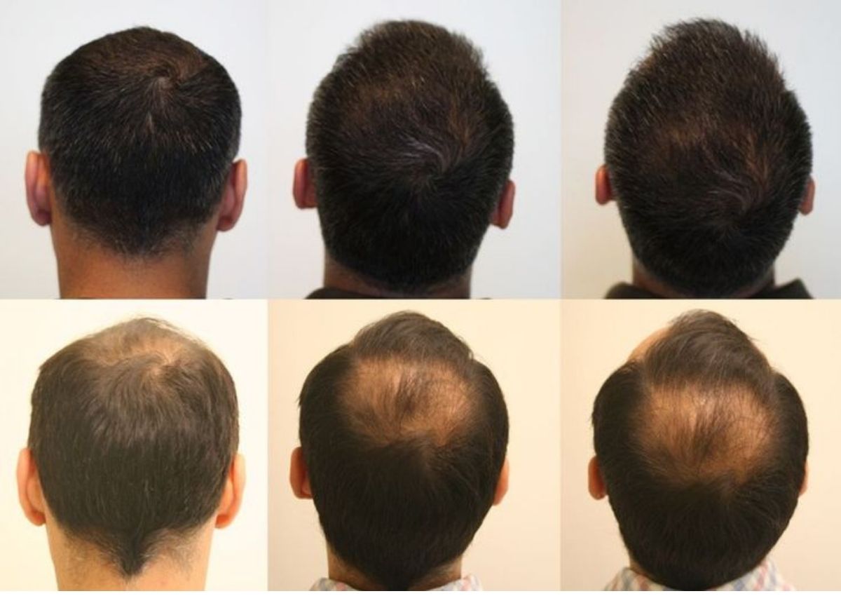 Best hair wigs and hair patches for men in kolkata, starting just ₹4999. Best non surgical hair replacement solution for pattern baldness in men with the help of advanced hair patching with hair wigs and hair patches for men in kolkata.