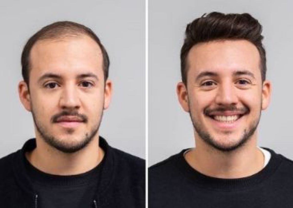Best hair wigs and hair patches for men in kolkata, starting just ₹4999. Best non surgical hair replacement solution for pattern baldness in men with the help of advanced hair patching with hair wigs and hair patches for men in kolkata.