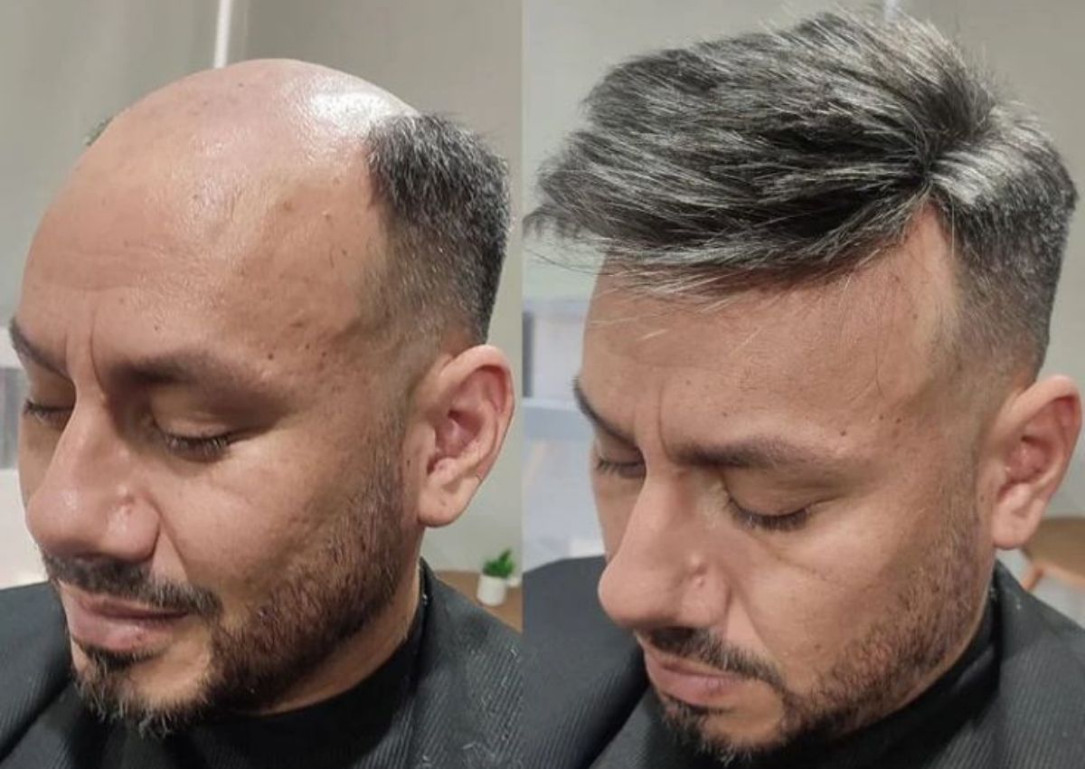 Best hair wigs and hair patches for men in kolkata, starting just ₹4999. Best non surgical hair replacement solution for pattern baldness in men with the help of advanced hair patching with hair wigs and hair patches for men in kolkata.