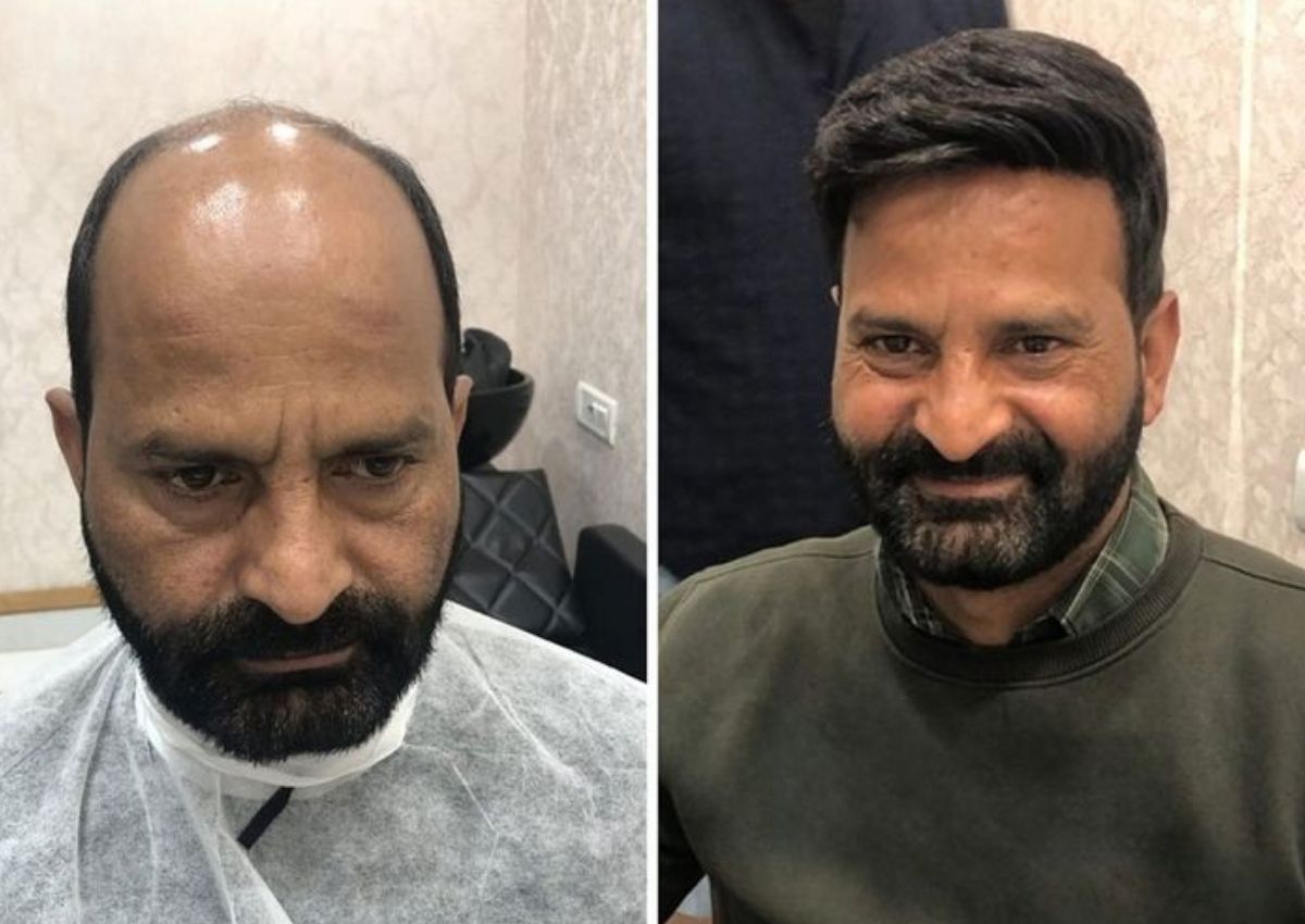 Best hair wigs and hair patches for men in kolkata, starting just ₹4999. Best non surgical hair replacement solution for pattern baldness in men with the help of advanced hair patching with hair wigs and hair patches for men in kolkata.