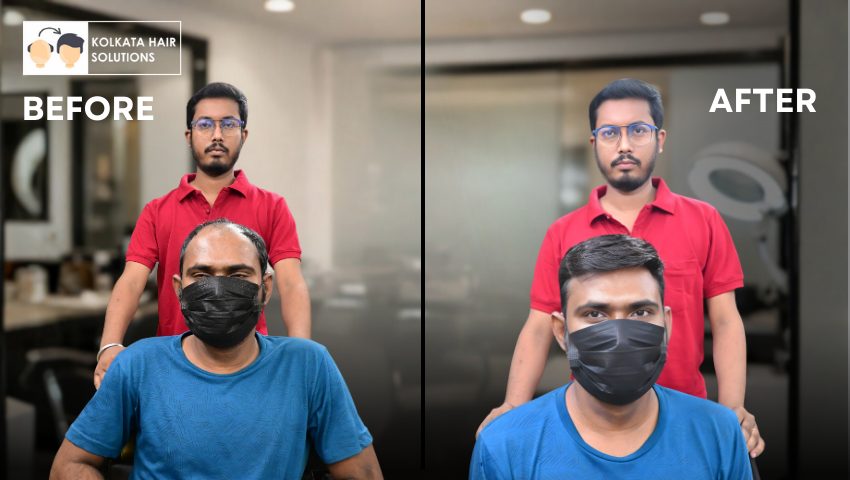 Hair Fixing Expert in Kolkata